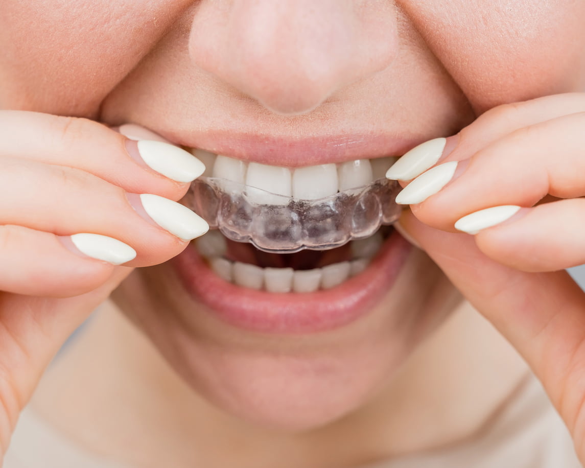 Retainers Fareham Orthodontist Near Me